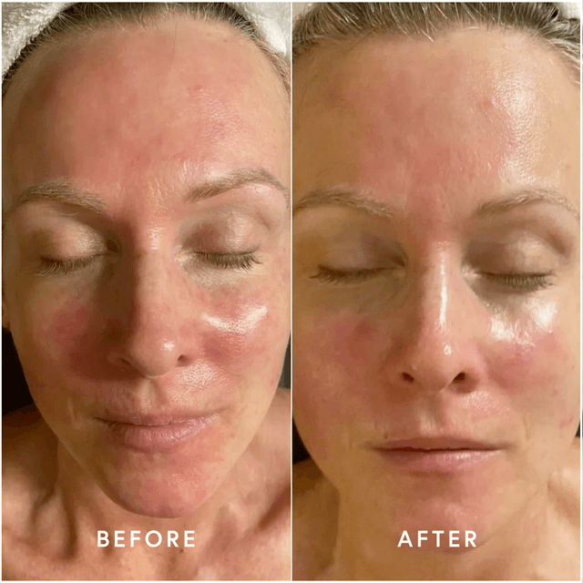 Epicutis-Post Procedure Set