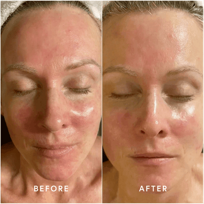 Epicutis-Post Procedure Set