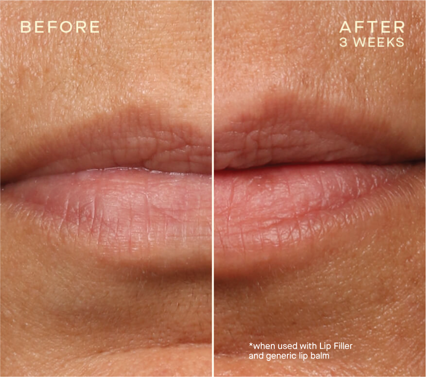 Ourself LIp Filler